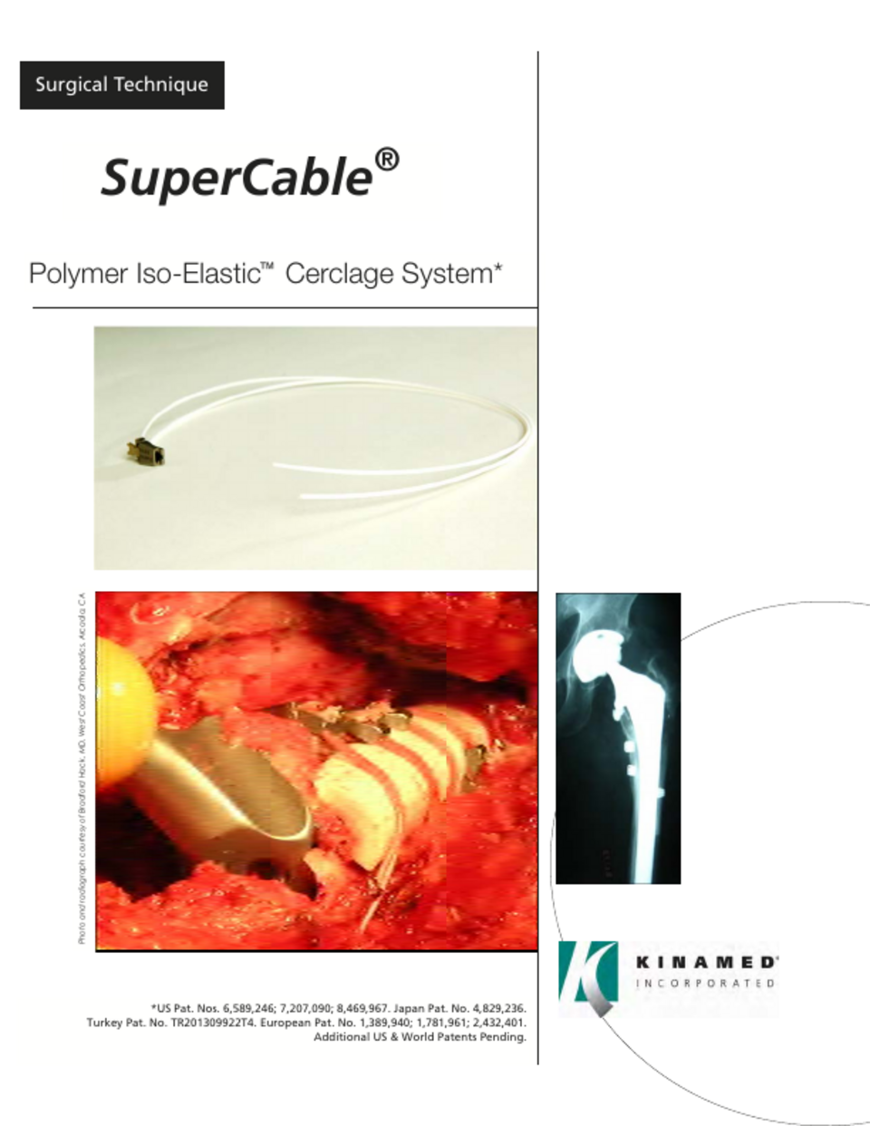 SuperCable Polymer Iso-Elastic Cerclage System Surgical Technique